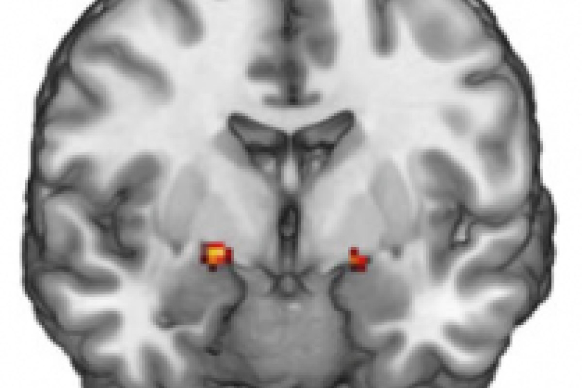 MRI image showing activity in the amygdala