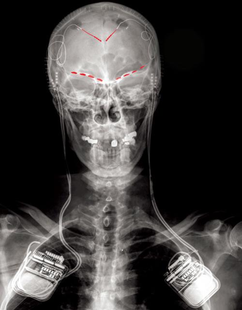 xray of patient with implants